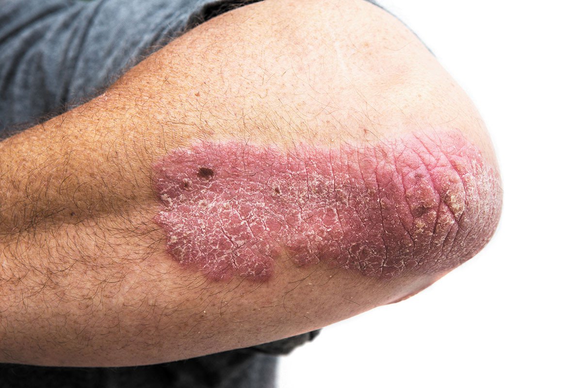 ​Psoriasis Is More Than Skin Deep: Could Molecular Hydrogen Help? cover
